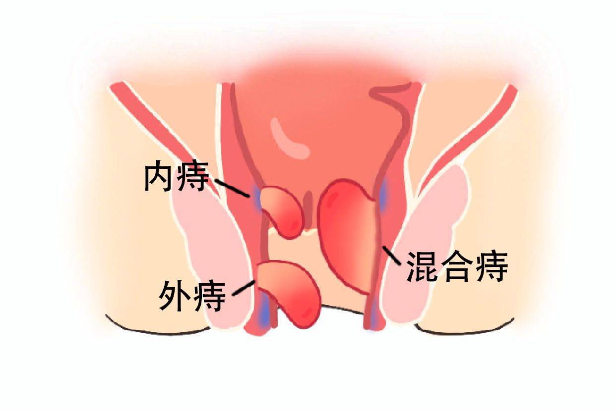 道县新区医院 | 痔疮有多少种